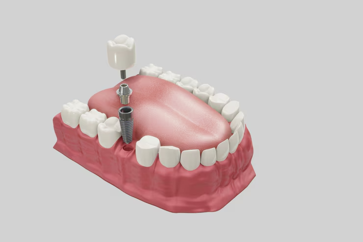 Implants dentaires Hongrie : Pourquoi sont-ils la solution idéale pour un sourire parfait et abordable ?